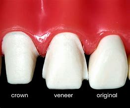 Image result for Crowns Vynil