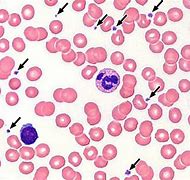 Image result for Thrombosis Histology