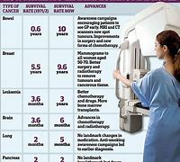 Image result for Pancreatic Cancer Recurrence Life Expectancy