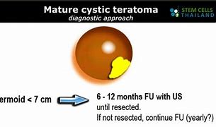 Image result for Teratoma