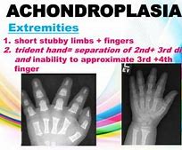 Image result for Trident Hand Achondroplasia