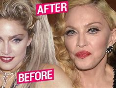 Image result for Madonna Today Plastic Surgery