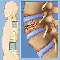 Image result for Lumbar Compression Burst Fractures