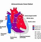 Image result for Complete Atrioventricuar Canal