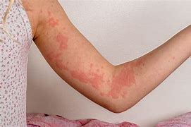 Image result for Hives with Pustules