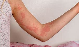 Image result for Hives with Pustules