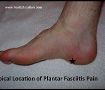 Image result for Plantar Fascia Ligament Pain