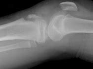 Image result for Avulsion Fracture