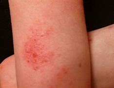 Image result for Eczema On Dark Skin Photos