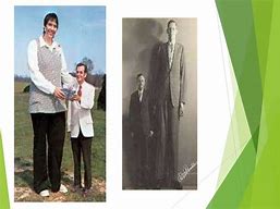 Image result for Gigantism Acromegaly and Dwarfism