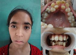 Image result for Malar Hypoplasia