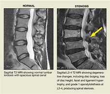 Image result for Lumbar Spine MRI 8Mm