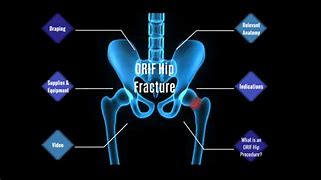 Image result for Orif Hip