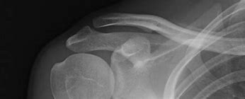 Image result for Shoulder MRI