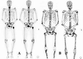 Image result for DDR and Bone Metastasis