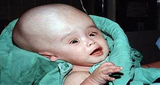 Image result for Hydrocephalus