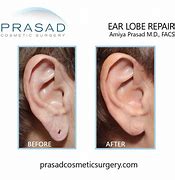 Image result for Torn Ear