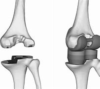 Image result for Left Knee Arthroplasty