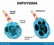 Image result for Empyema in Children Cartoon