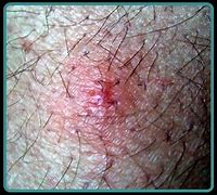 Image result for Bird Nest Mites