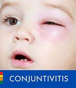 Image result for Conjuntivitis