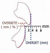 Image result for Overjet Bite