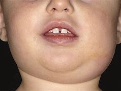 Image result for Mumps Child