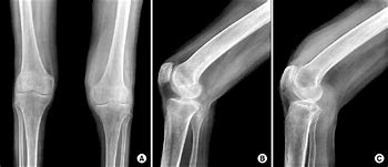 Image result for Patellofemoral Joint Space Narrowing