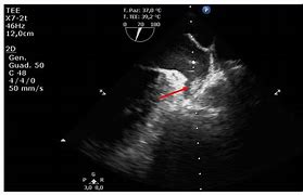 Image result for Left Atrial Appendage Thrombus On Toe