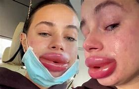 Image result for Bad Lip Fillers