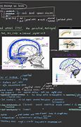 Image result for Sinus Thrombosis