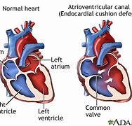 Image result for Tof with Atrioventricular Canal Defect