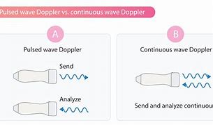 Image result for Pedal Pulse Doppler