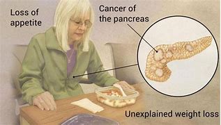 Image result for Pancreatic Cancer Recurrence Life Expectancy