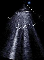 Image result for B Lines On Ultrasound Cartoon