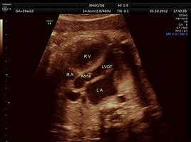 Image result for LVOT Rvot Ultrasound