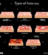 Image result for Pustules and Inflammatory Acne