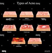 Image result for Papule Pimple