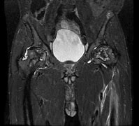 Image result for Avascular Necrosis Pathology