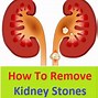 Image result for Kidney Stone Remedy