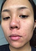 Image result for Banish Acne Scars