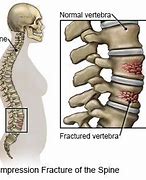 Image result for Compression Fracture Lumbar Surgery