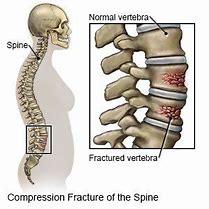 Image result for Imagees Compression Fracture of Lumbar Vertebrae