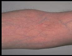 Image result for Atrophy From Steroid Injection