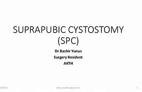 Image result for Suprapubic Cystostomy