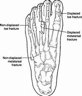 Image result for Broken Toe Bone