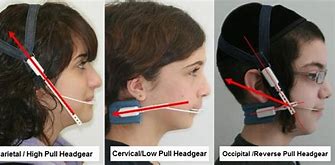 Image result for Orthodontic Headgear