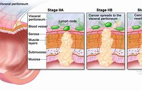 Image result for Adenocarcinoma Rectal Cancer