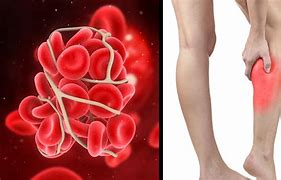 Image result for Heart Blood Clot