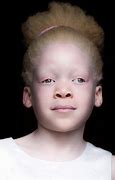 Image result for South African Albino Child